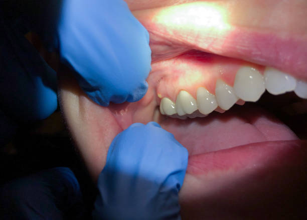 Emergency Dental Filling Replacement in NJ